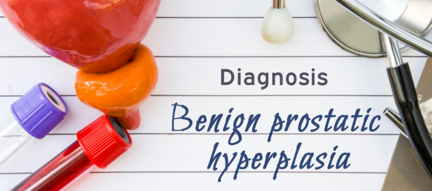 Você sabe o que é Hiperplasia Prostática Benigna?